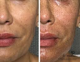 Atrévete a probar PhiIon Plasma Pen Este procedimiento transfiere la  energía solo a las partes superficiales de la piel sin afectar los tejidos  más profundos. El generador de plasma resulta en la