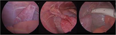 We did not find results for: Extrapulmonary Sequestration With A Left Internal Thoracic Arterial Feeding Vessel In An Infant Treated With Video Assisted Thoracoscopic Resection A Case Report Journal Of Cardiothoracic Surgery Full Text