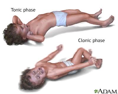 Febrile seizures