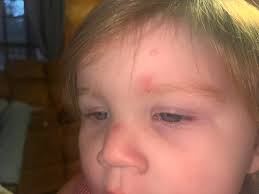 Hi moms I am experiencing something awful. This morning I woke up with  these hive like rashes all over my body and face. I have not switched  detergent used any new soaps