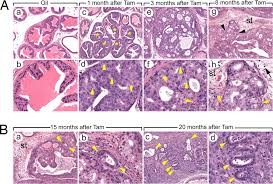 Given the poor results of treatment with radiation or surgery alone, it is increasingly common to use a combination of treatment strategies. Temporally Controlled Ablation Of Pten In Adult Mouse Prostate Epithelium Generates A Model Of Invasive Prostatic Adenocarcinoma Pnas