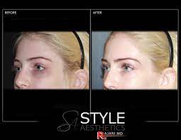 Unlike dermal fillers, prf improves under eye pigmentation and skin firmness/texture/thickness in addition to. Under Eye Filler Style Aesthetics By Rajanimd