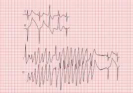 Veranderungen Des Qt Intervalls Ecg
