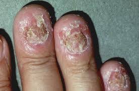 A psoríase nas unhas dos pés e nas unhas pode parecer muito com fungos. Psoriase Sintomas Tipos E Tratamento Orientacao Medica Essencial