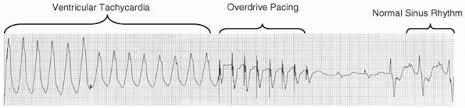 Furthermore, overdrive suppression of repetitive purkinje fibre activity is a well known electrophysiological phenomenon. The Ecg Of Cardiac Pacemakers Basic And Bedside Electrocardiography 1st Edition 2009