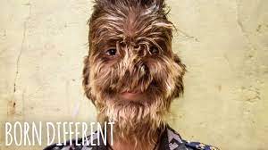 While you might not see many cases of werewolf syndrome, some people do still get it today. The Boy With Werewolf Syndrome Born Different Youtube