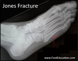 A variety of devices can be used to fixate a jones fracture, including screws, bone plates, wires, or pins. Jones Fracture Footeducation