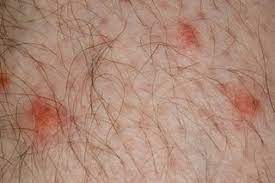 What does it look like? Insect Bites And Stings Symptoms Nhs