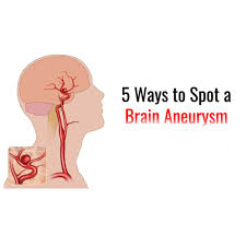 But this depends on your health and the aneurysm. 5 Ways To Spot A Brain Aneurysm Womenworking