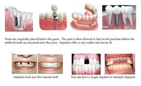 More news for how dental implants work » Arlington Dental Center S Dr Bradberry Dental Implants
