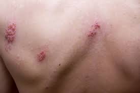 Welche symptome bei einer gürtelrose auftreten. Herpes Lippenherpes Gurtelrose Und Genitalherpes