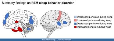 Image result for REM Sleep Behavior Disorder