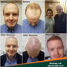 Best Hair Transplant Doctor In Turkey In 2020 Hair Transplant Hair Transplant Uk Best Hair Transplant