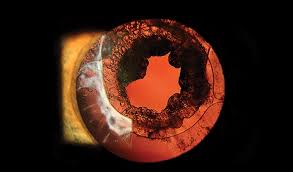 The Art Of Eyes Cataract Surgery Cataract Eyes