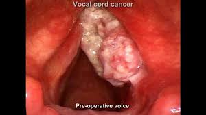 It is continuous with the trachea below and the pharynx posterosuperiorly. Laryngeal Cancer