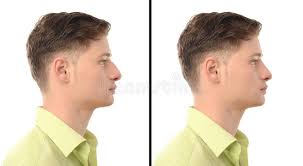 Before And After Photos Of A Young Man With Nose Job Plastic Surgery Man With R Ad Man Nose Photos Y Nose Job Rhinoplasty Nose Jobs Plastic Surgery