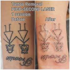 You just got a tattoo and need to take care of it. Tattoo Removal Dls Clinic