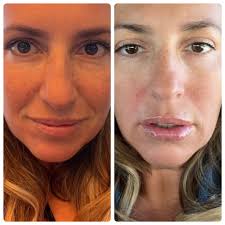 I'm looking to get filler in my temples and nasolabial folds! Who would you  guys recommend?