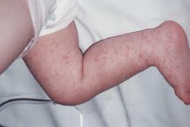 An italian report, compiled by dr sebastiano recalcati at alessandro manzoni hospital, shows that just over 20 percent of coronavirus patients had skin rashes. Baby Rash Pictures Causes Treatments Mommyhood101