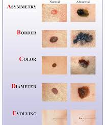There are a great many efforts underway to educate, raise awareness, and provide resources to encourage individuals to change their behaviors to escape the. May Is Melanoma Awareness Month American Dermatology Associates