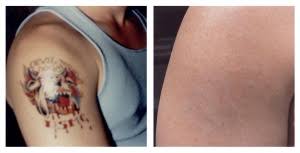 Part of our constant evolution is sparked from past experiences, fueling our fire to learn, grow, and eventually move forward. Laser Tattoo Removal Scottsdale Clients Thank Shelley Cook National Laser Institute Medical Spa