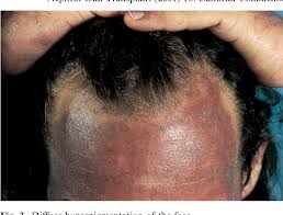 Image result for Diffuse Hyperpigmentation