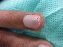 Image result for Glomus tumor