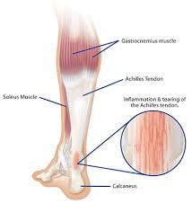 The achilles tendon is the largest tendon in the body connecting insertional achilles tendonitis. Achilles Tendonitis Icb Medical