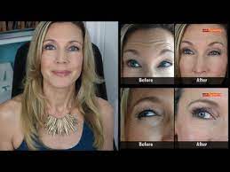 In some cases, the results of treatment last far longer than six months. Botox Results Mature Skin Crows Feet Forehead Wrinkles Youtube