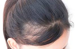 Stress causes permanent hair loss in women. Does Dry Shampoo Cause Hair Loss