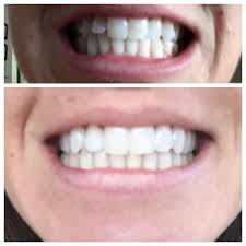 Sarahbee Xoxo On Instagram Before After Invisalign Invisalignsmile Straightteethclub I Invisalign Cosmetic Dentistry Services Straight Teeth