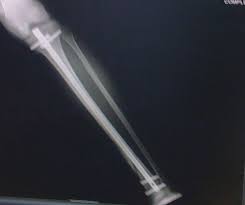 Airport metal detectors are quite sensitive to metals, this includes metal implants that may have been placed inside your body. Im Nail And Metal Detectors 21st Century Boy