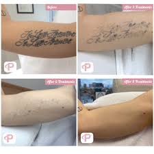 Maybe you would like to learn more about one of these? Laser Tattoo Removal Before And After Photos Premium Tattoo Removal