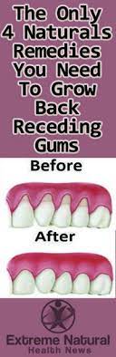 The Only 4 Natural Remedies You Need To Grow Back Receding Gums Http Www Extremenaturalhealthnews Com The On Gum Health Grow Back Receding Gums Receding Gums