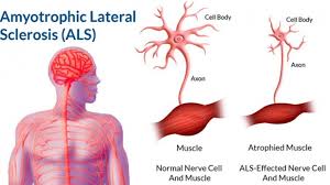 These neurons die over time. Amyotrophic Lateral Sclerosis Als Symptoms Diagnosis And Treatment Medika Life Neurological Diseases