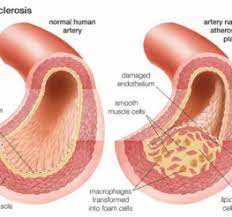 Atherosclerosis Vs Arteriosclerosis Difference