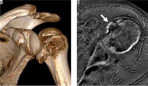Image result for Shoulder MRI
