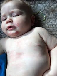 Learn what eczema in babies looks like, plus what triggers baby eczema and how to treat it naturally. James Ordinary Guy Reviews Vaniply For Baby Eczema