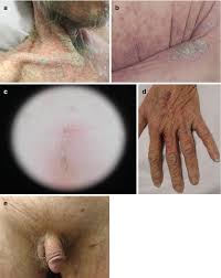 Image result for scabies in the groin area