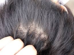 In this post, you will learn about: How To Get Rid Of Dandruff 9 Natural Home Remedies For A Flake Free Scalp