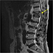 Related online courses on physioplus. Thoracic Spine Compression Fractures Vertebra Plana Radiologypics Com