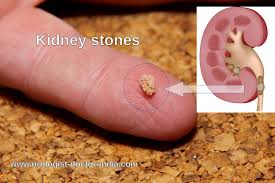 Pin On Kidney Stones