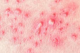 Image result for sore skin in the groin area