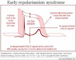 Image result for Early Repolarization