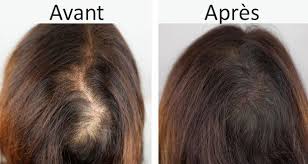 Un Masque Naturel Pour Ne Plus Perdre Vos Cheveux Chute De Cheveux Anti Chute Cheveux Perte De Cheveux