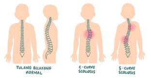 Skoliosis - Tulang belakang melengkung