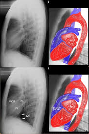 Lateral Chest X Ray Cardiomegaly Heart
