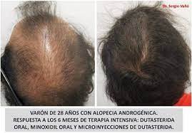 Dutasteride (avodart) capsules for hair loss. Dutasteride Injections For Hair Loss Hair Loss Cure 2020