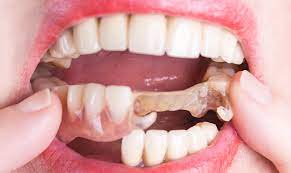 Whilst with complete dentures, this image is not. Preparing Patients For Partials