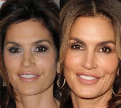 Cindy Crawford Plastic Surgery Cindy Crawford Plastic Surgery Botox Fillers